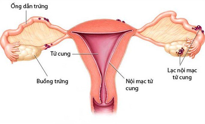 Lạc nội mạc tử cung: Nguyên nhân, triệu chứng, chẩn đoán và điều trị