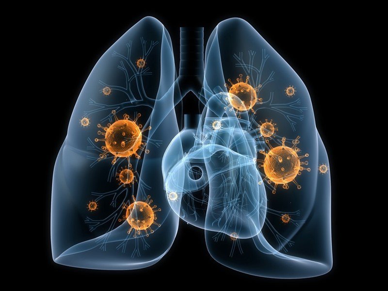 Được chẩn đoán ung thư phổi tế bào nhỏ giai đoạn lan rộng có nghĩa là gì?