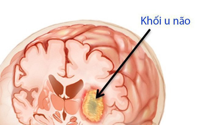 Khối u não ở người lớn