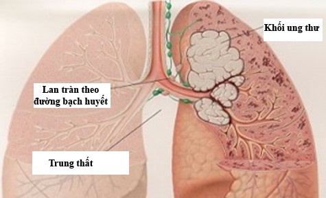 Chăm sóc người bị ung thư phổi: Những điều cần biết