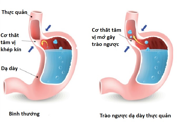 Cập nhật về các yếu tố nguy cơ của ung thư thực quản (Phần 1)