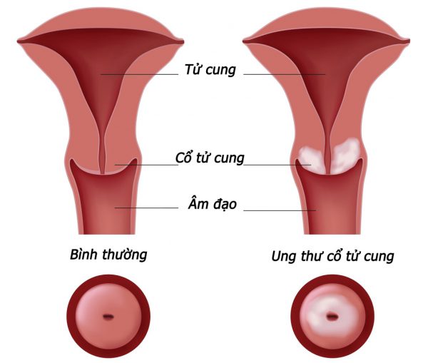 Chẩn đoán hình ảnh ung thư cổ tử cung