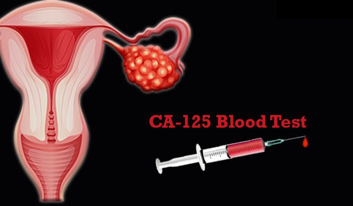 CA 125: Dấu ấn của ung thư buồng trứng