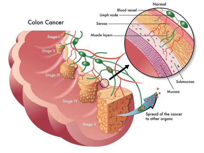 Ung thư ruột kết giai đoạn II: Điều trị hay không điều trị?