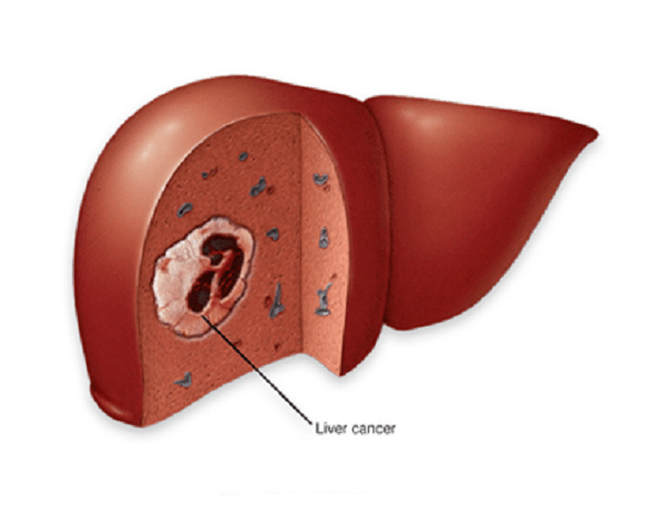 Cắt gan điều trị ung thư biểu mô tế bào gan (HCC)