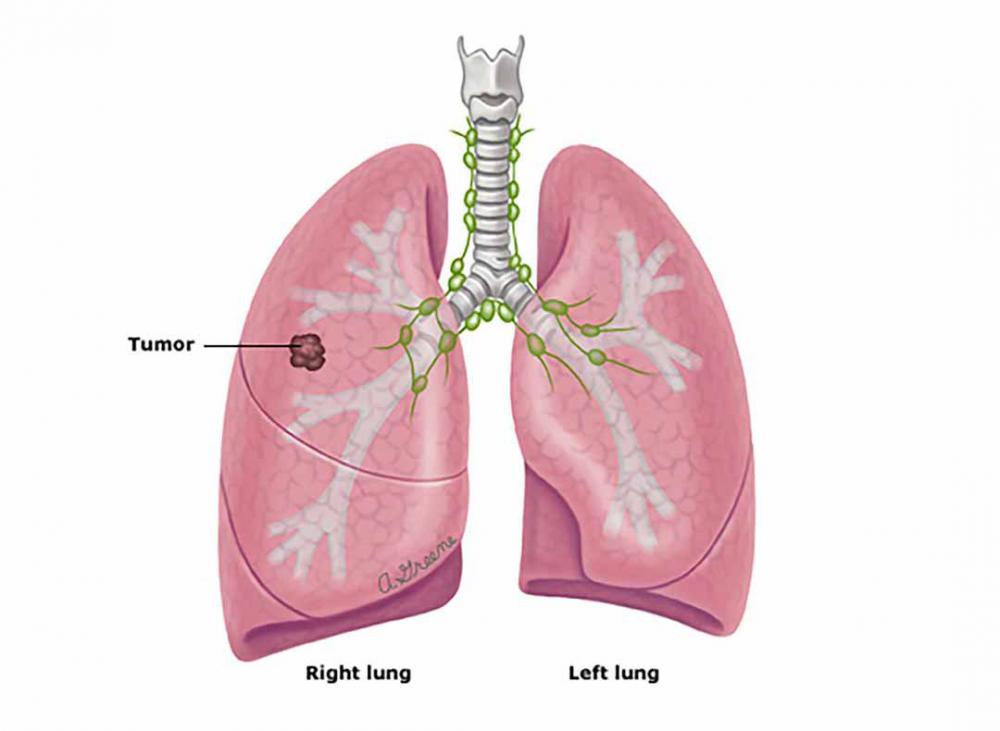 Tiên lượng của bệnh nhân khi được chẩn đoán ung thư phổi không tế bào nhỏ
