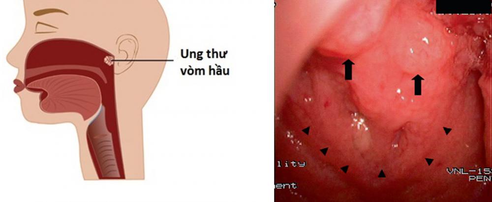 Các dấu hiệu của ung thư vòm họng