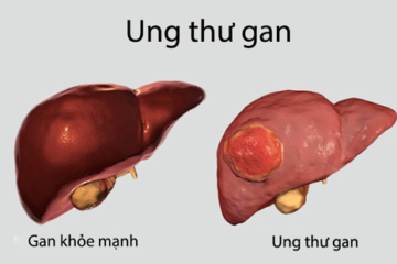 Ung thư gan: Nguyên nhân, triệu chứng, chẩn đoán và điều trị