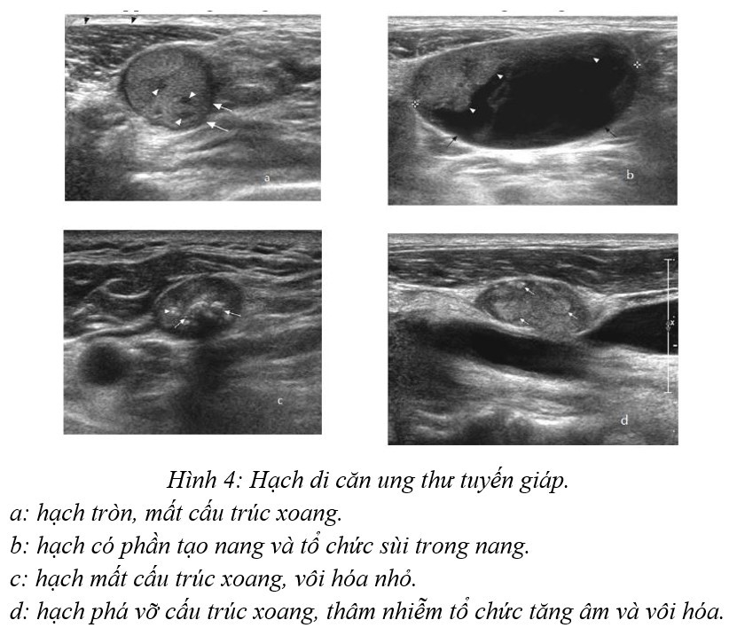 Đánh giá các hạch tuyến giáp