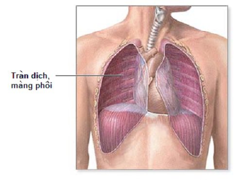 6 lầm tưởng về bệnh ung thư phổi bạn nên biết