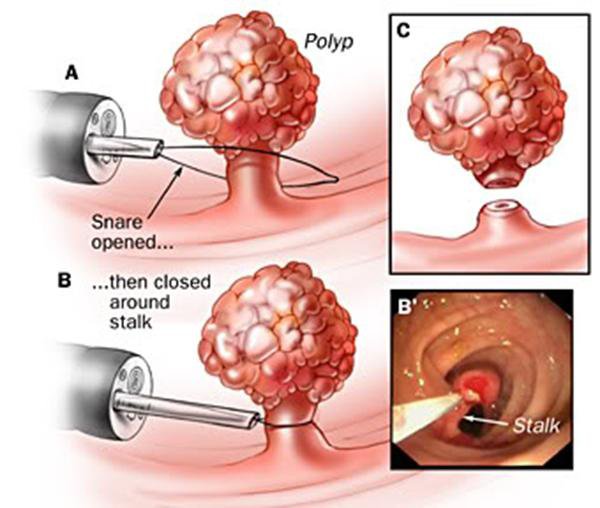 Phân tầng nguy cơ bệnh nhân để tránh bỏ sót polyp đại trực tràng và vai trò của trí tuệ nhân tạo