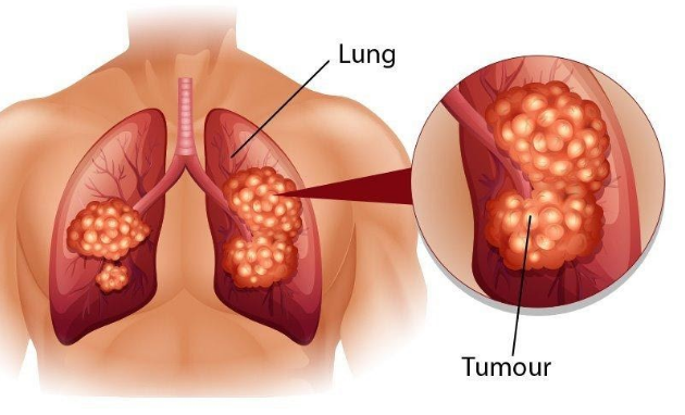 Các dấu ấn ung thư phổi: Những điều cần biết