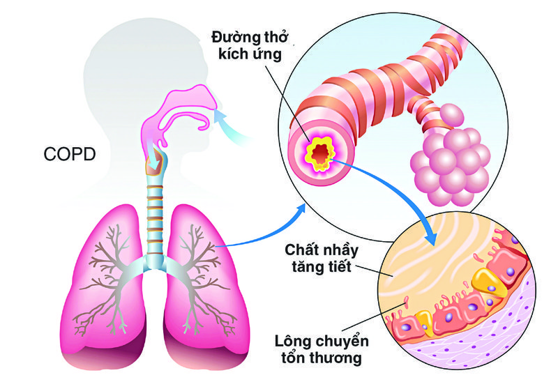 Mối liên hệ giữa COPD và ung thư phổi