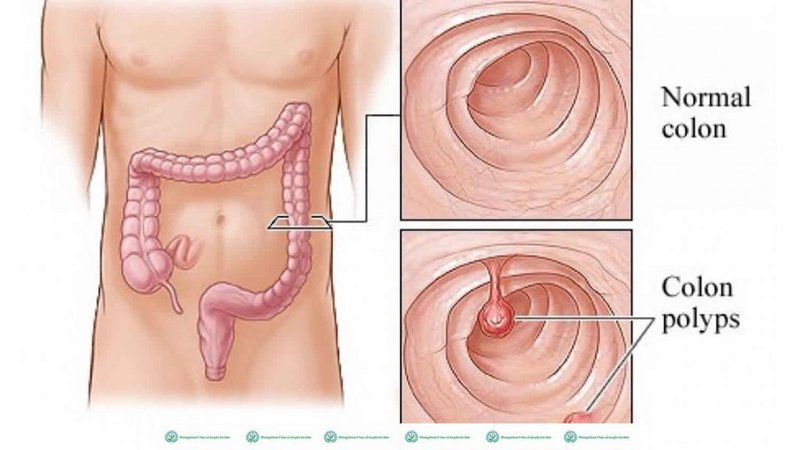 Adenocarcinoma là gì?