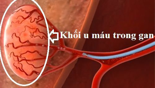 Cập nhật điều trị u mạch gan