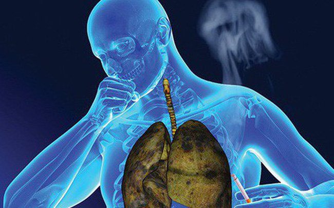 Vai trò của xạ trị trong điều trị ung thư phổi