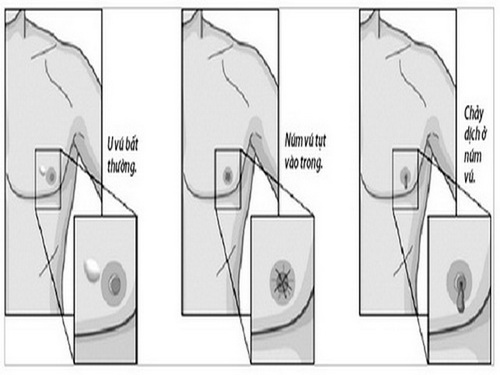 Dấu hiệu ung thư vú ở nam giới