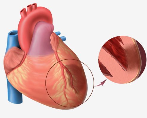 Bạn biết gì về ung thư tim?