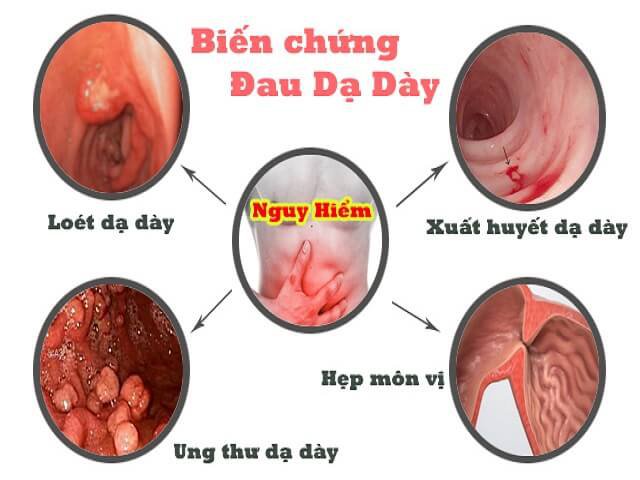 Các biến chứng của ung thư dạ dày