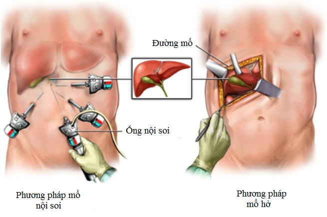 Phẫu thuật cắt túi mật trong điều trị ung thư