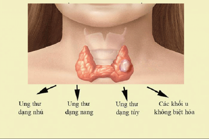 Dấu hiệu ung thư tuyến giáp giai đoạn cuối