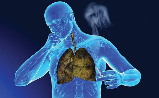 Ung thư phổi có dễ nhầm với các bệnh hô hấp khác?